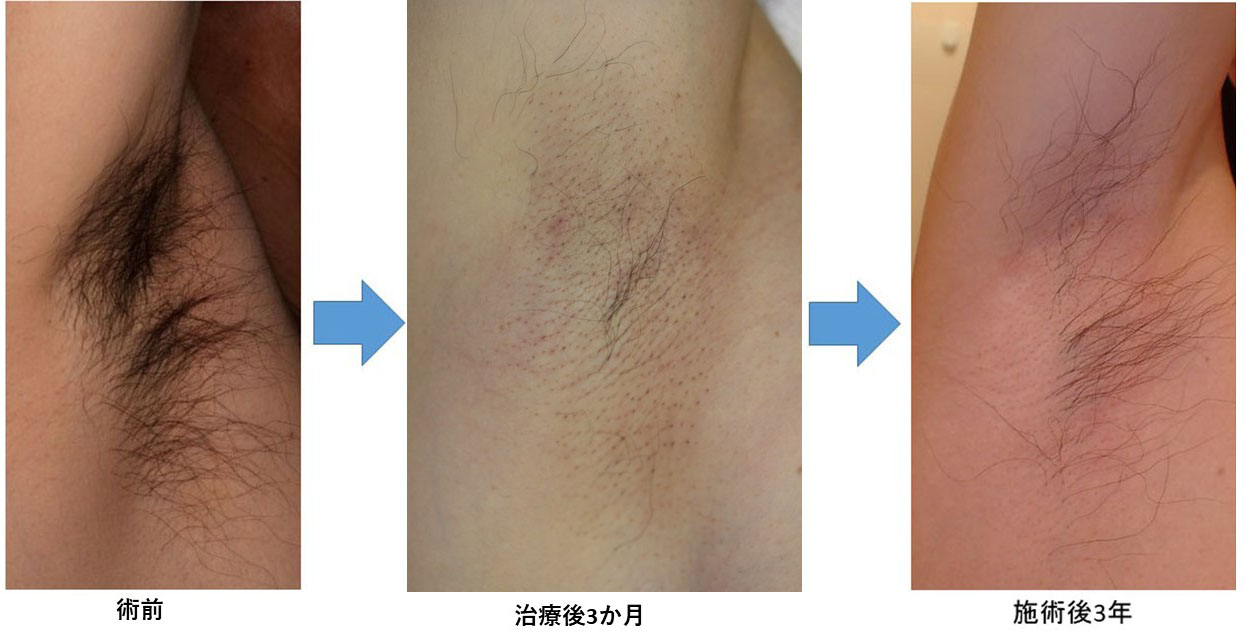 ローラー クランプ 法 失敗