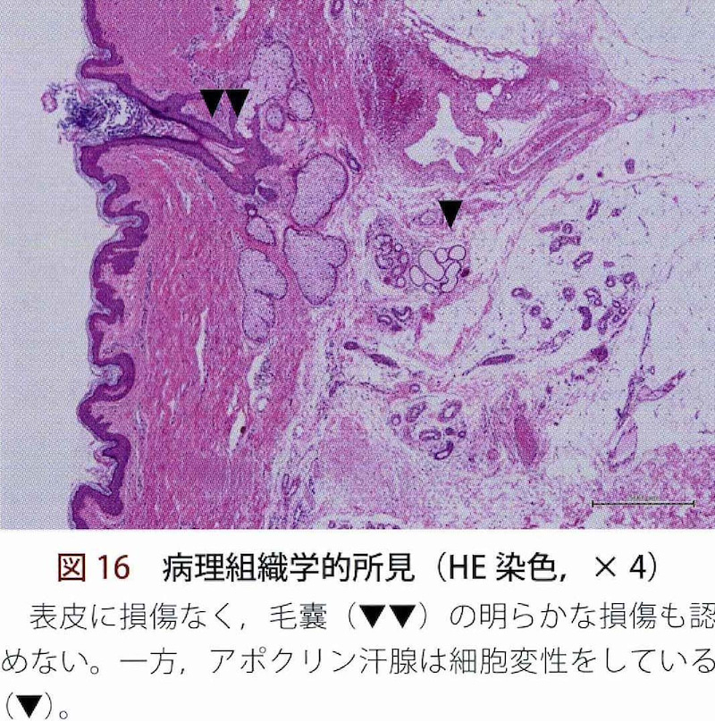 形成外科　２０１６年増刊号、  (6)フラクショナルRF（ビューホット）より引用